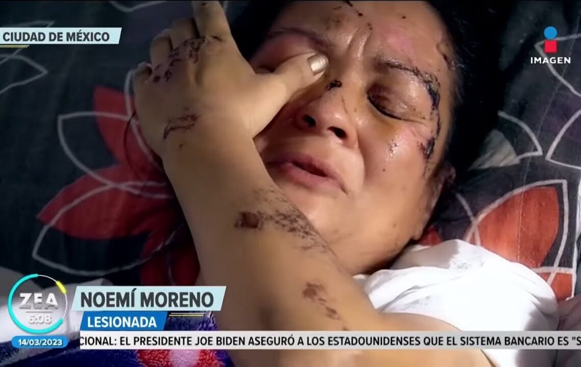 Mujer quedó postrada en una cama tras ser atropellada | Noticias Francisco Zea | Programa 14/03/2023