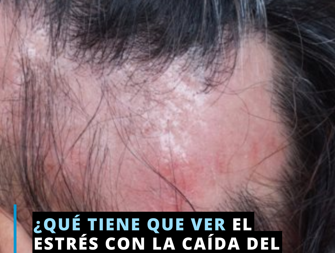 El estrés y la caída del cabello El estrés y la caída del cabello