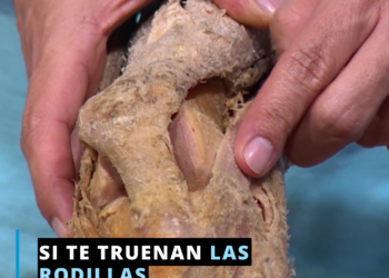 Si te truenan las rodillas