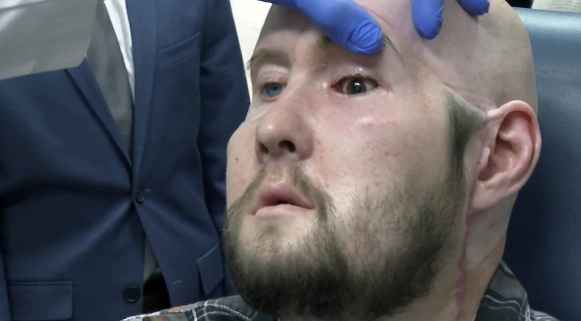 Cirujanos han realizado el primer trasplante de ojo completo del mundo
