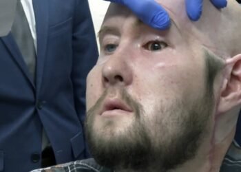Cirujanos han realizado el primer trasplante de ojo completo del mundo