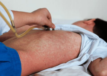 Aumenta riesgo de sarampión por casos importados