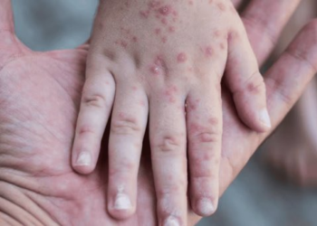 Registra la Secretaría de Salud cuatro casos importados de sarampión