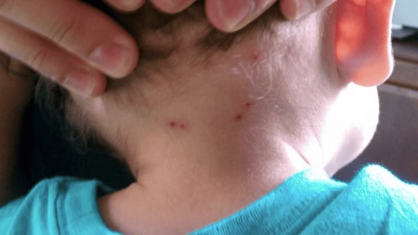 Más casos de rickettsia en Hermosillo que 90% de estados Más casos de rickettsia en Hermosillo que 90% de estados