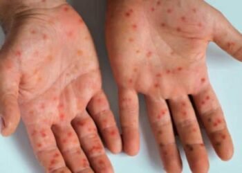 Mpox en México: Cofepris aprueba vacuna ‘Jynneos’