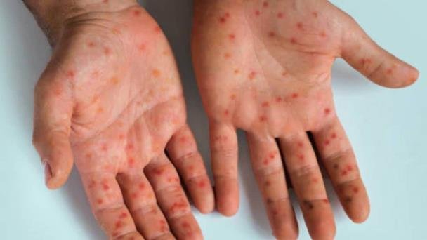 Mpox en México: Cofepris aprueba vacuna ‘Jynneos’ Mpox en México: Cofepris aprueba vacuna ‘Jynneos’