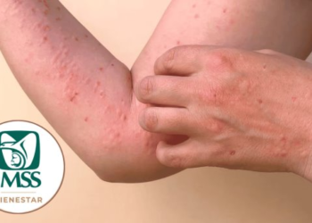 ¿Cuáles son los Alerta síntomas de mpox, viruela del mono?