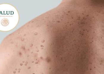 Aumenta el riesgo por contagio de mpox en México