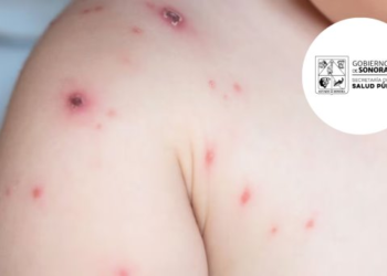 Pacientes con Mpox en Sonora serán dados de alta pronto