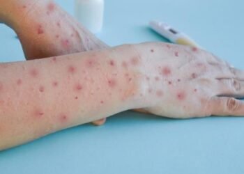 Confirman dos casos de viruela del mono o mpox en Sonora