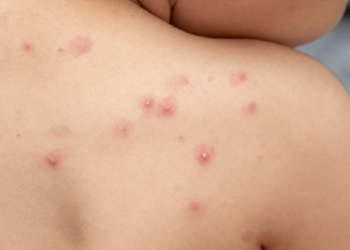 aumentan a 53 casos confirmados