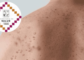 Analizan caso sospechoso de Mpox en Sonora
