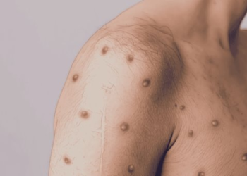 ¿Mpox puede desatar una nueva pandemia?