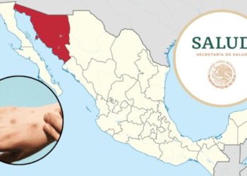 México llega a 61 casos de viruela del mono; Sonora incluida