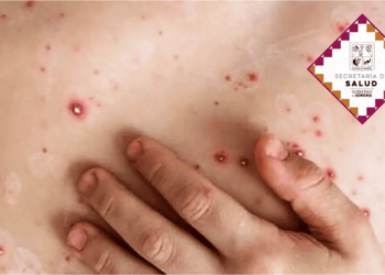 Casos de Mpox en Sonora siguen sin aumentar