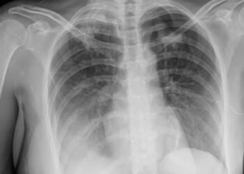Sonora se posiciona como el segundo estado con más casos de tuberculosis: suman 1,322 en 2025 Sonora se posiciona como el segundo estado con más casos de tuberculosis: suman 1,322 en 2025