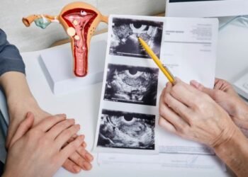 Actualizan nombre del síndrome de ovario poliquístico por razones médicas